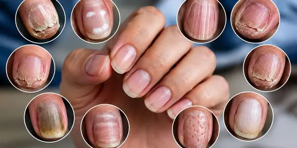 ناخن‌هایتان چه چیزی درباره سلامت بدنتان می‌گویند؟