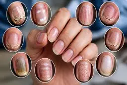 ناخن‌هایتان چه چیزی درباره سلامت بدنتان می‌گویند؟